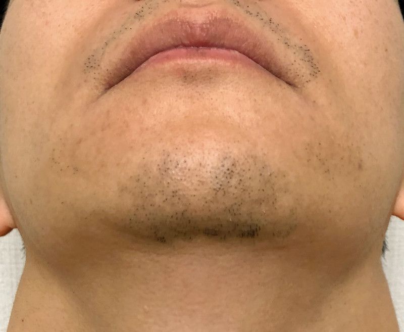 ヒゲ脱毛から2週間後の鼻下とあごのヒゲ3部位の状態