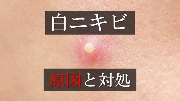 【必見】髭脱毛後の白ニキビは放っておいても大丈夫?発生する原因と対処法を徹底解説! | まるわかりメンズ脱毛