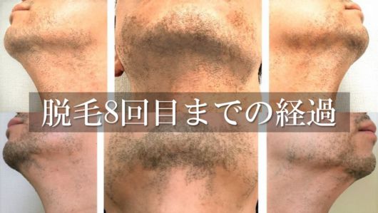 ヒゲ脱毛中は【肌の乾燥】に要注意!脱毛効果が下がる理由と ...